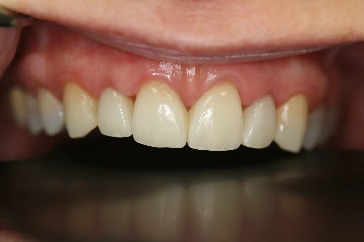 Anterior Veneers — after treatment