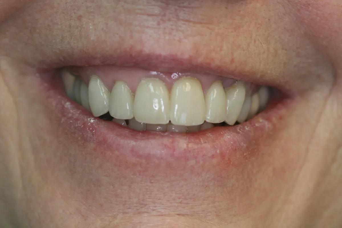 Porcelain Veneers — after treatment