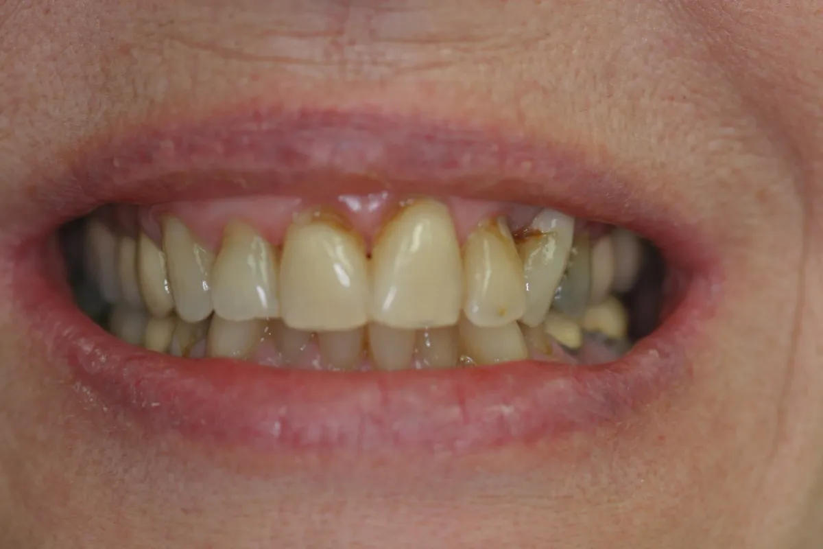 Porcelain Veneers — before treatment